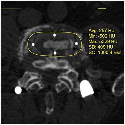 Circumferential Fusion Employing Transforaminal vs. Direct Lateral Lumbar Interbody Fusion—A Potential Impact on Implants Stability